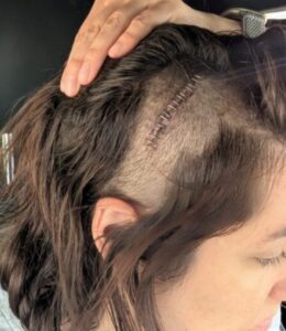 The shaved side of my head with surgical staples after emergency brain surgery to treat a chronic subdural hematoma.
