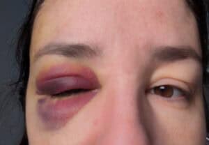 Close-up of the severe bruising and swollen black eye I developed after slipping on ice, months before a delayed brain bleed was diagnosed.